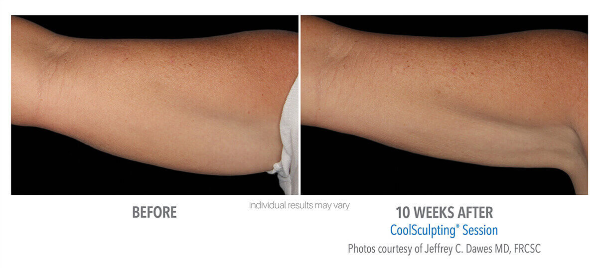 Under Arm Before and After