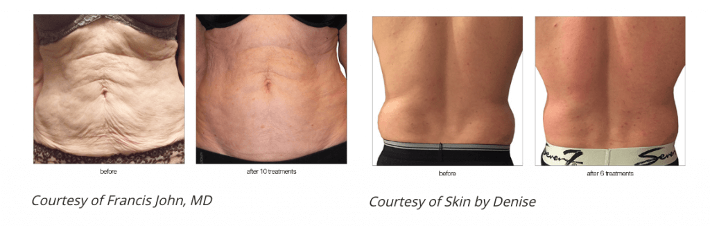 skin-tightening-before-and-after-2