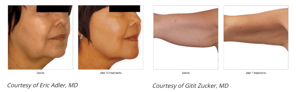 skin-tightening-before-and-after-3