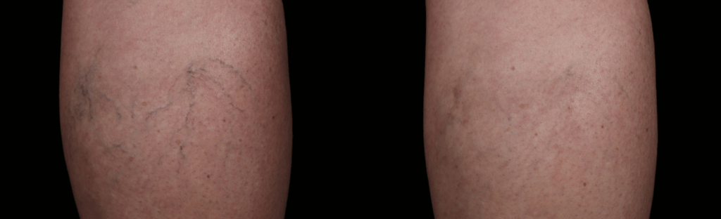 spider-vein-before-and-after1
