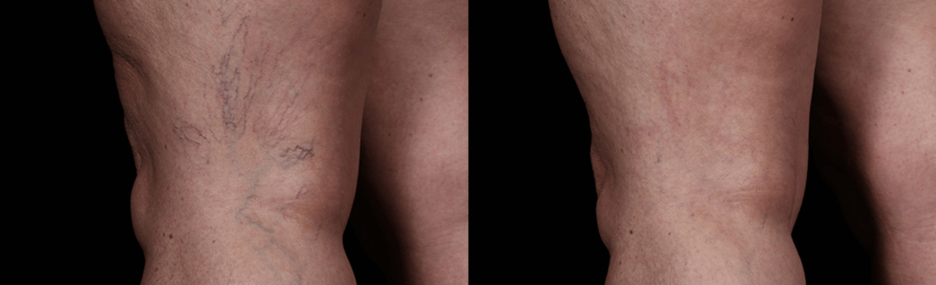 spider-vein-before-and-after2