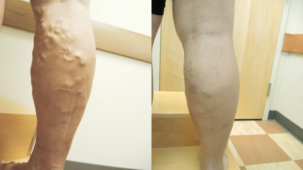 varicose-veins-before-and-after