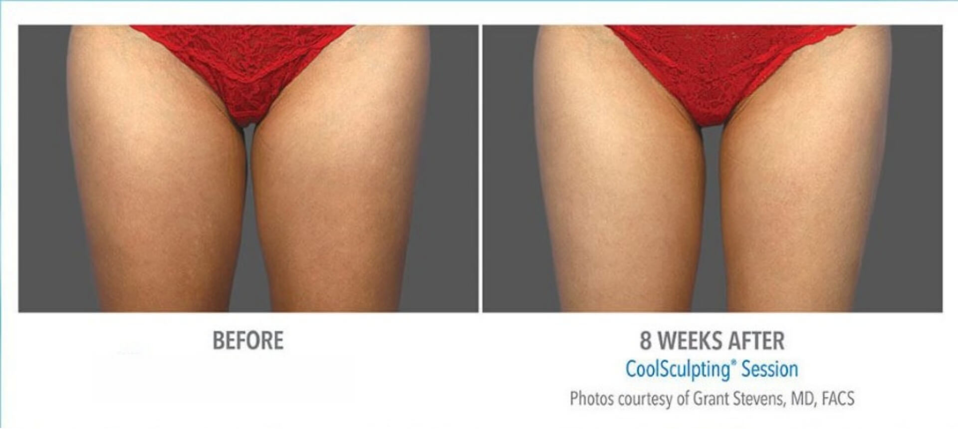 coolsculpting_10-before-and-after