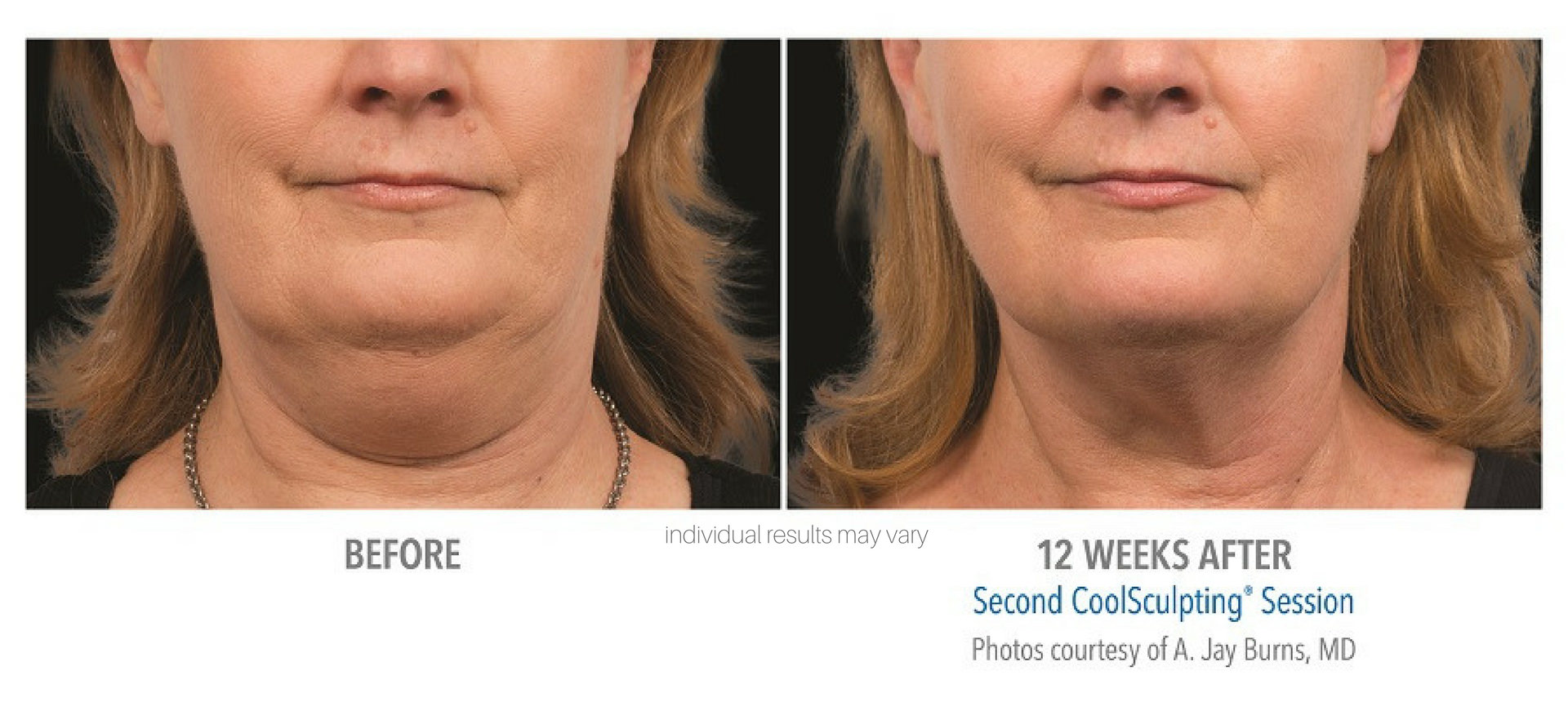 CoolSculpting Before And After Real Patient Photos Vein Laser Institute