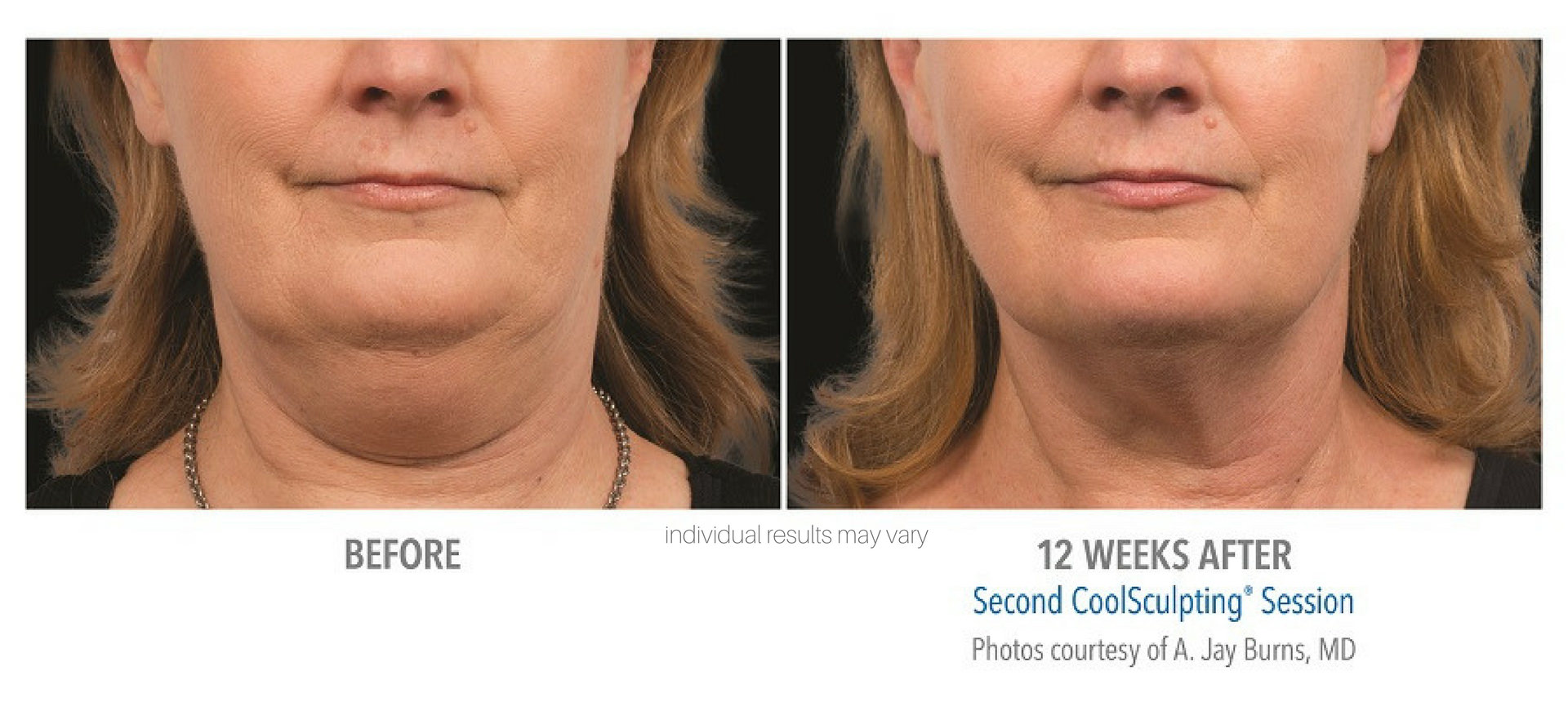 CoolSculpting Before And After Real Patient Photos Vein Laser 