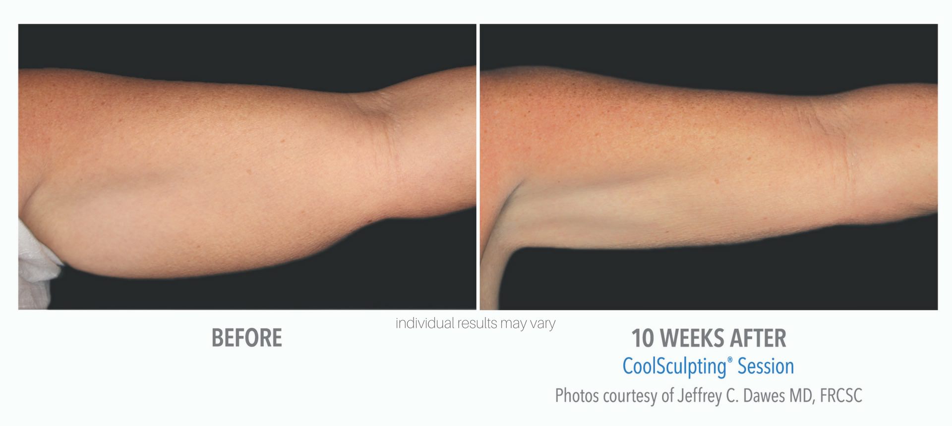 coolsculpting results for arm fat