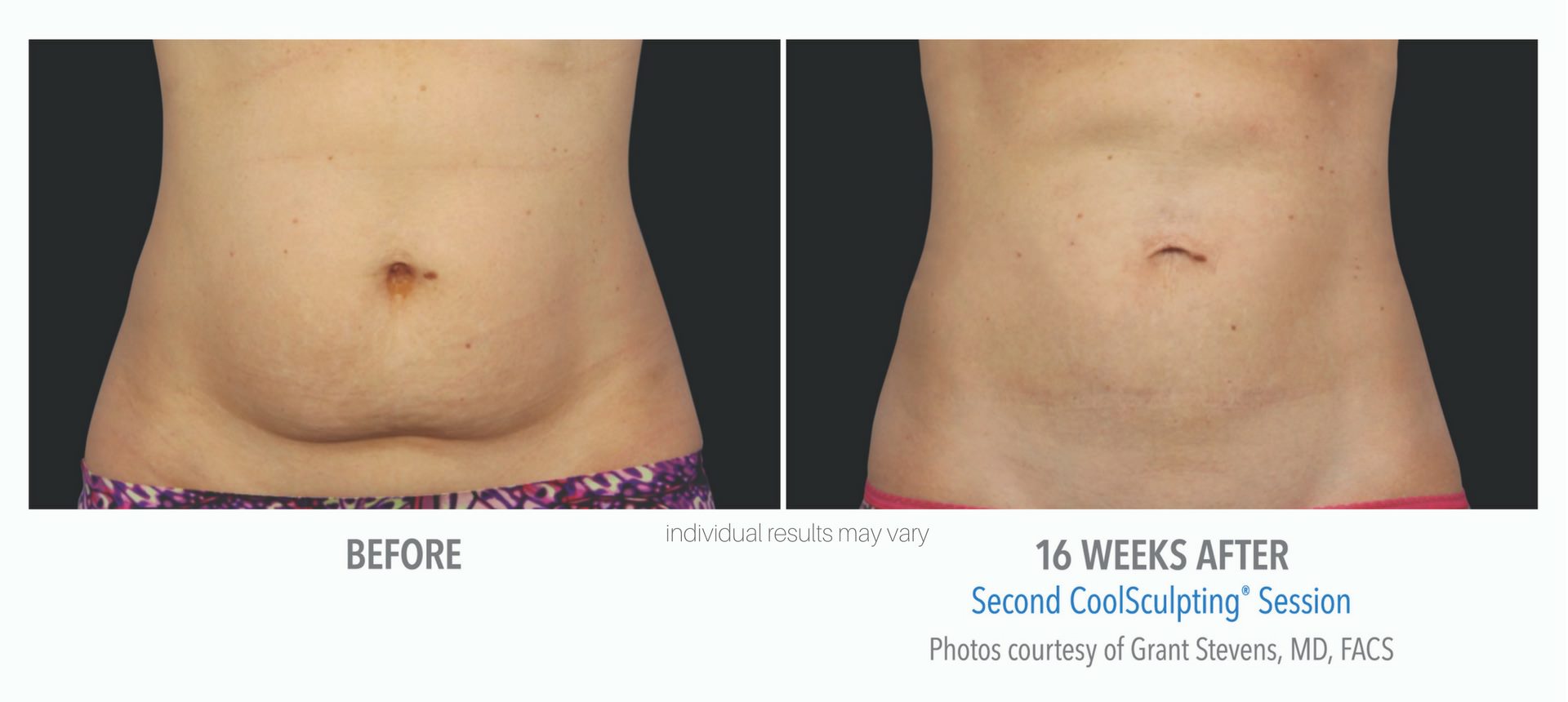CoolSculpting Before And After Real Patient Photos Vein Laser 