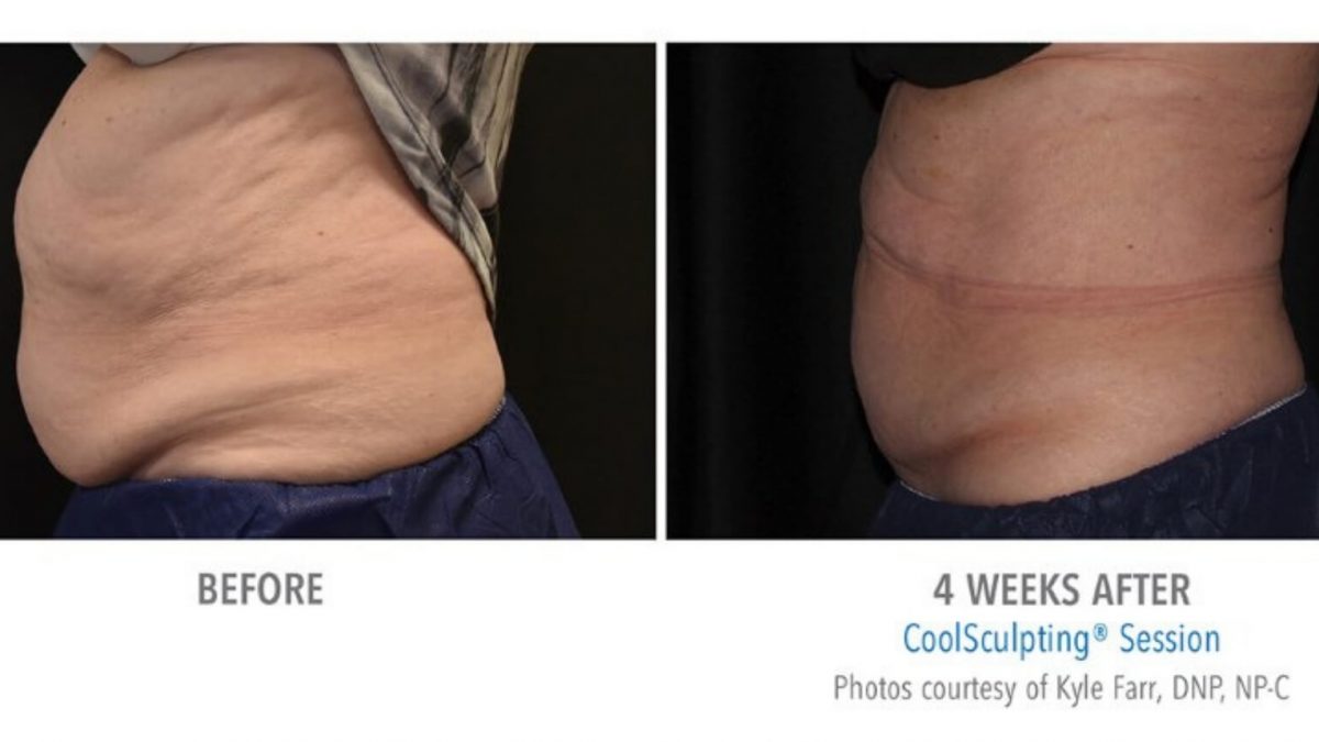CoolSculpting Before and After: Unveil Your Beauty