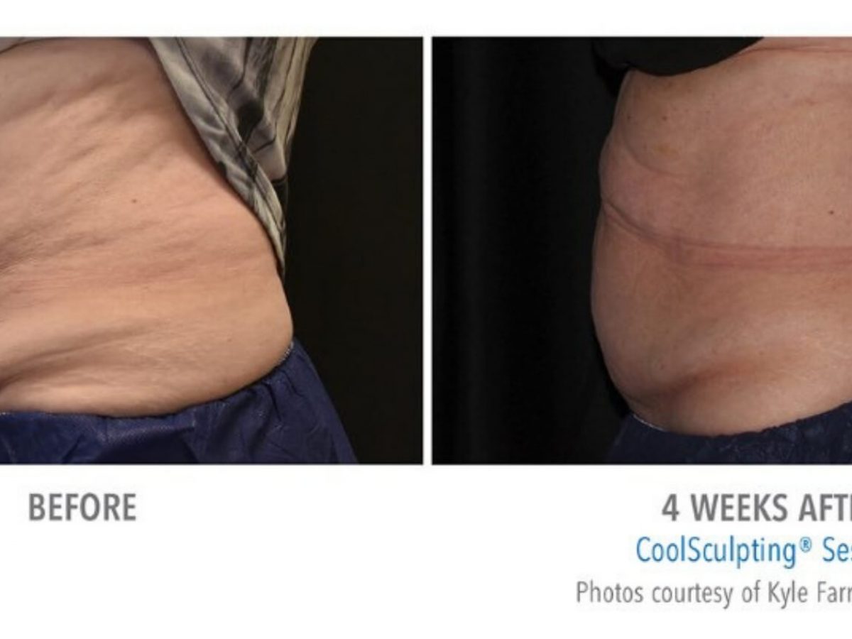 Coolsculpting Before And After Real Patient Photos Vein And Laser Institute