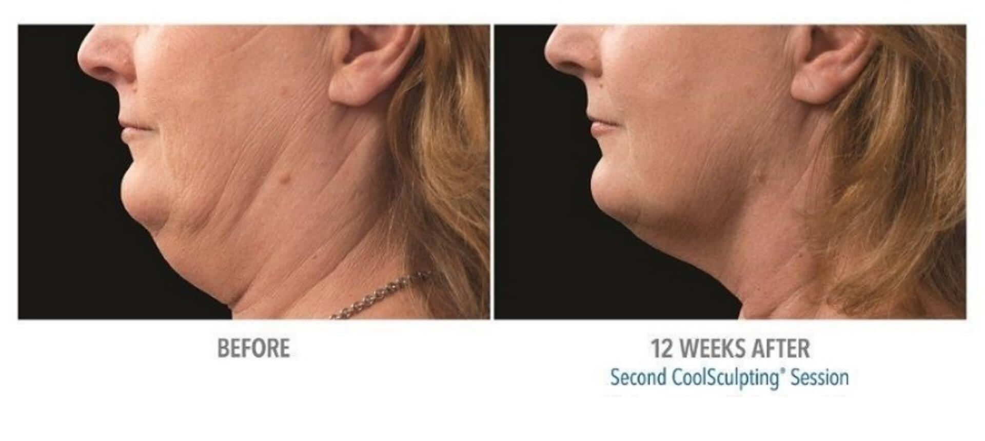 CoolSculpting before and after  Real Patient Photos - Vein & Laser  Institute