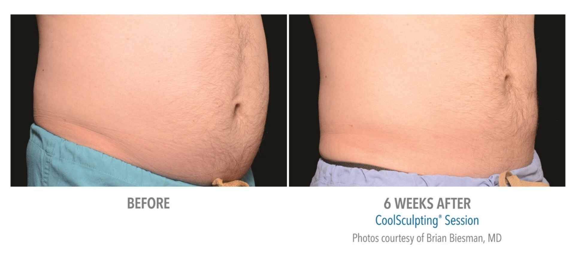 coolsculpting_9-before-and-after