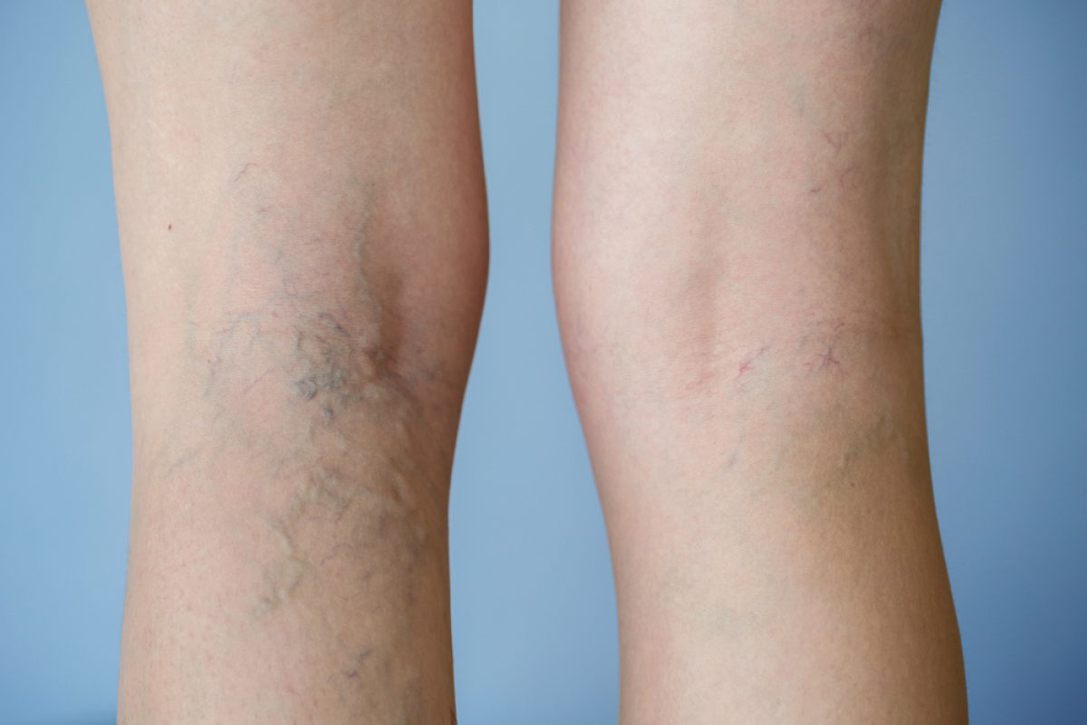 Setting The Record Straight: Myths and Facts About Varicose Veins