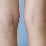 myths and facts about varicose veins
