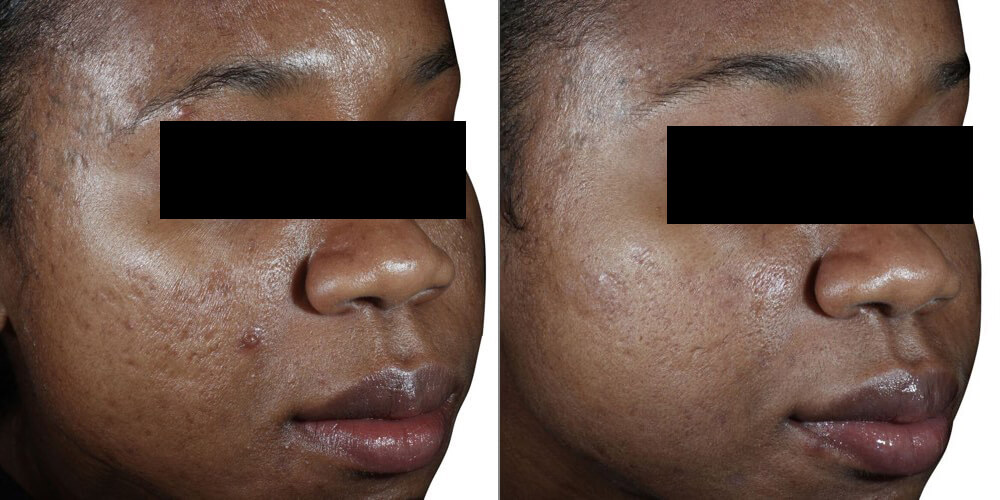 acne_scar_reduction-before-and-after-copy