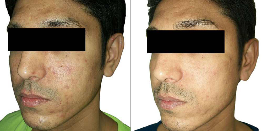acne_scar_reduction-before-and-after