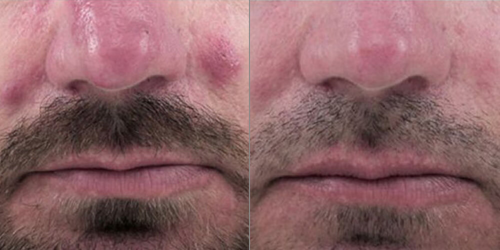 rosacea-treatment-before-and-after