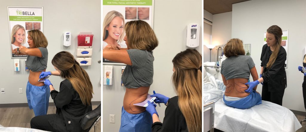 coolsculpting-consultation