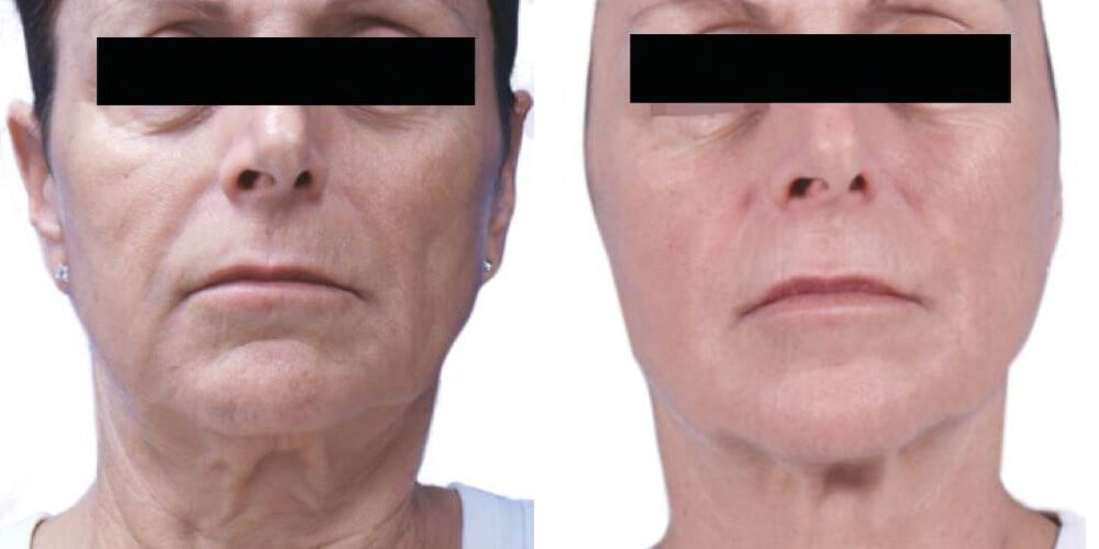 before and after skin tightening