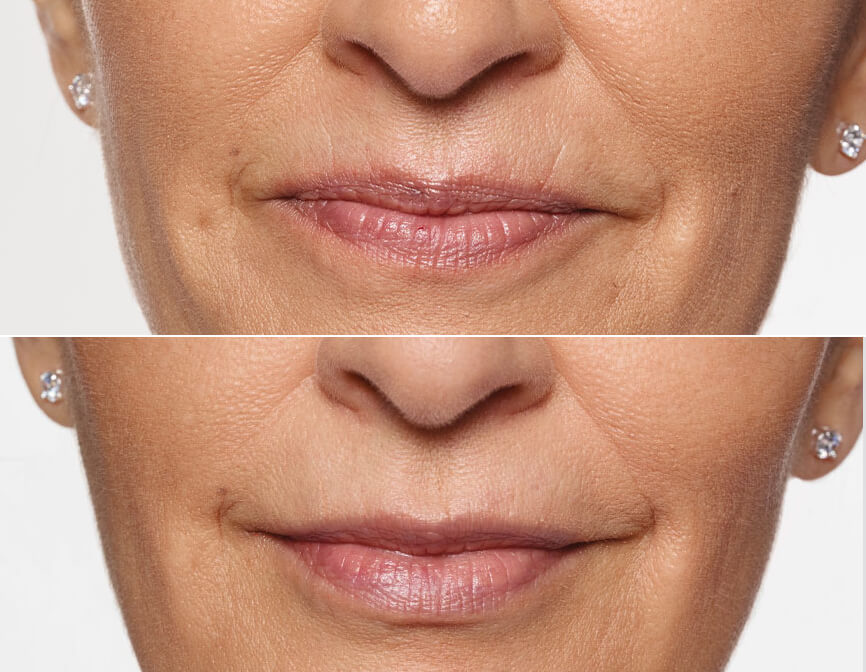 restylane-silk-lip-filler-before-and-after