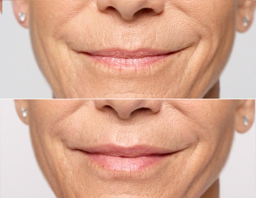 restylane-silk-lip-filler-before-and-after
