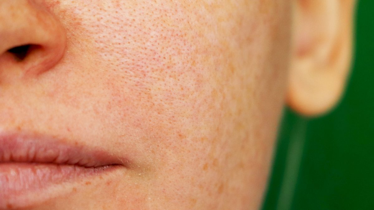 Laser Genesis: The Ultimate Way To Minimize Pores | Vein & Laser Institute