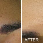 before and after hydrafacial treatment