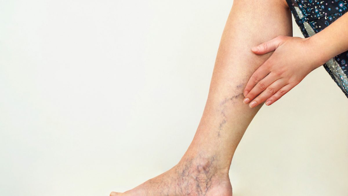 Varicele la picioare: ce sunt, de ce apar și cum le tratăm, Varicoză alergică