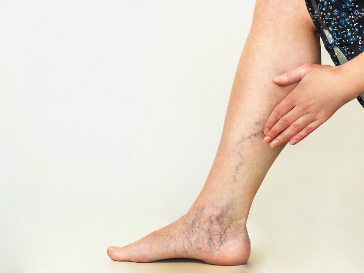 bandaje sau ciorapi varicoza bandaj pe picior în varicoza