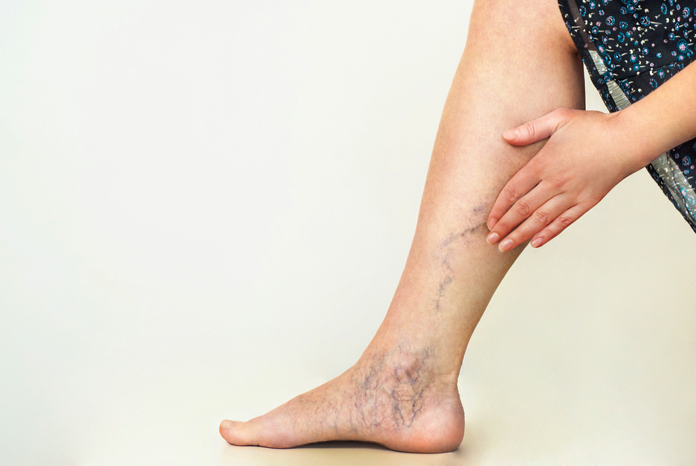 tratamentul venelor venice varicose pe picioarele unguentelor