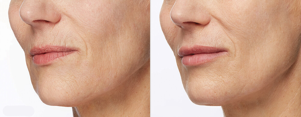 before and after dermal fillers