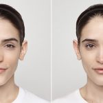 before and after dermal fillers