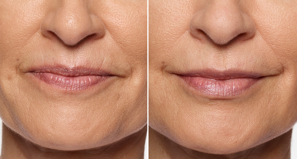 before and after dermal fillers
