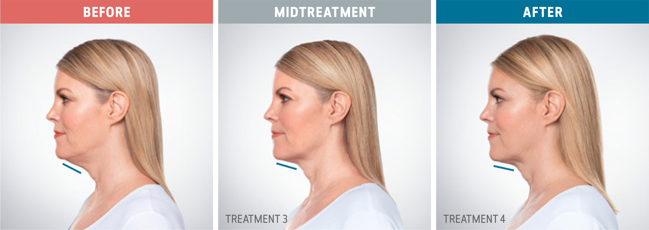 kybella-before-and-after