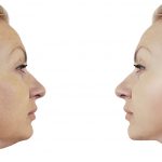 Dissolve unwanted chin fat with Kybella