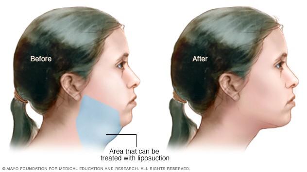 double chin liposuction diagram
