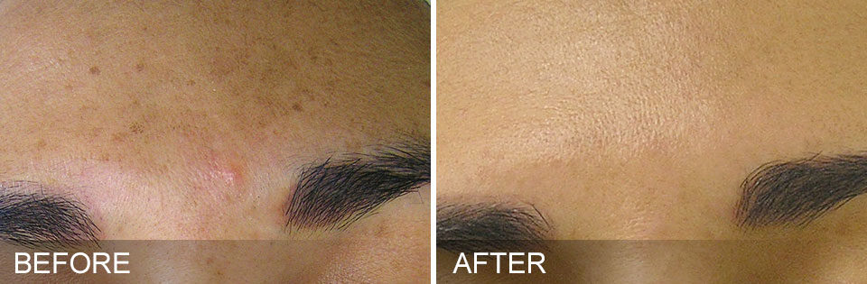 hydrafacial-before-and-after