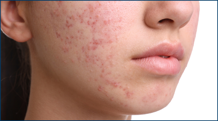 woman's lower face with acne