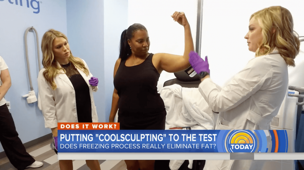 coolsculpting on the today show