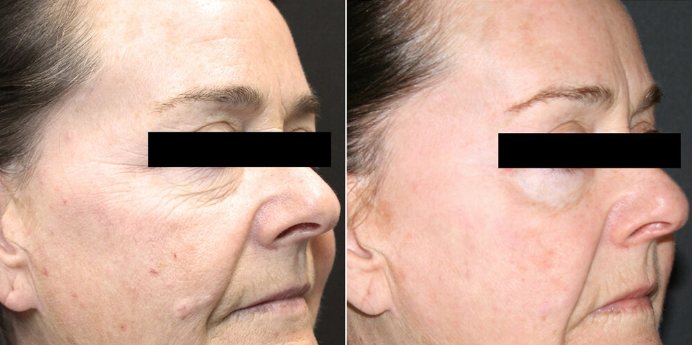 before and after tribella nonsurgical facelift
