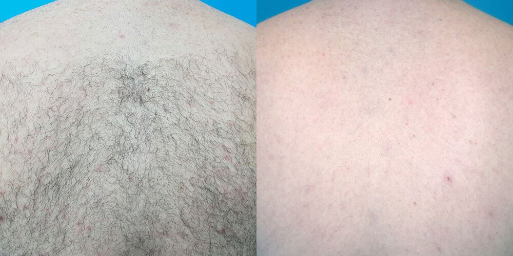 before-and-after-venus-velocity-hair-removal
