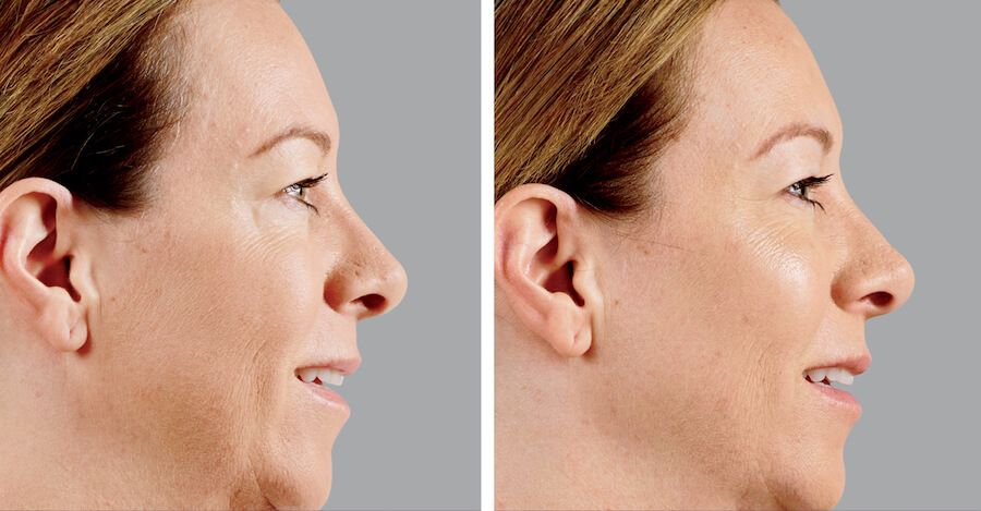 before-and-after-juvederm-voluma