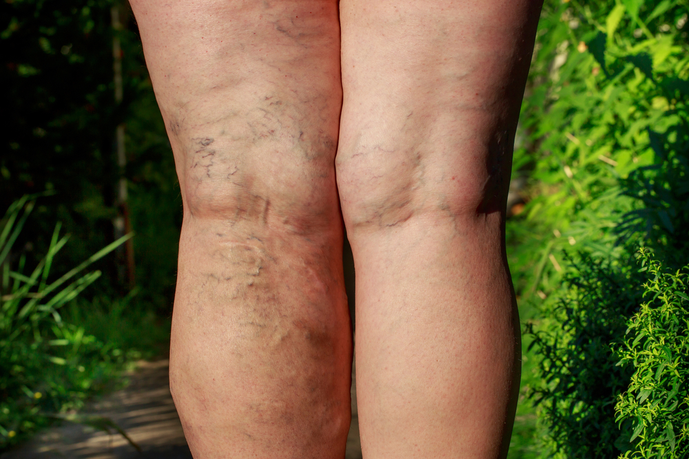 Endovenuous laser for varicose veins