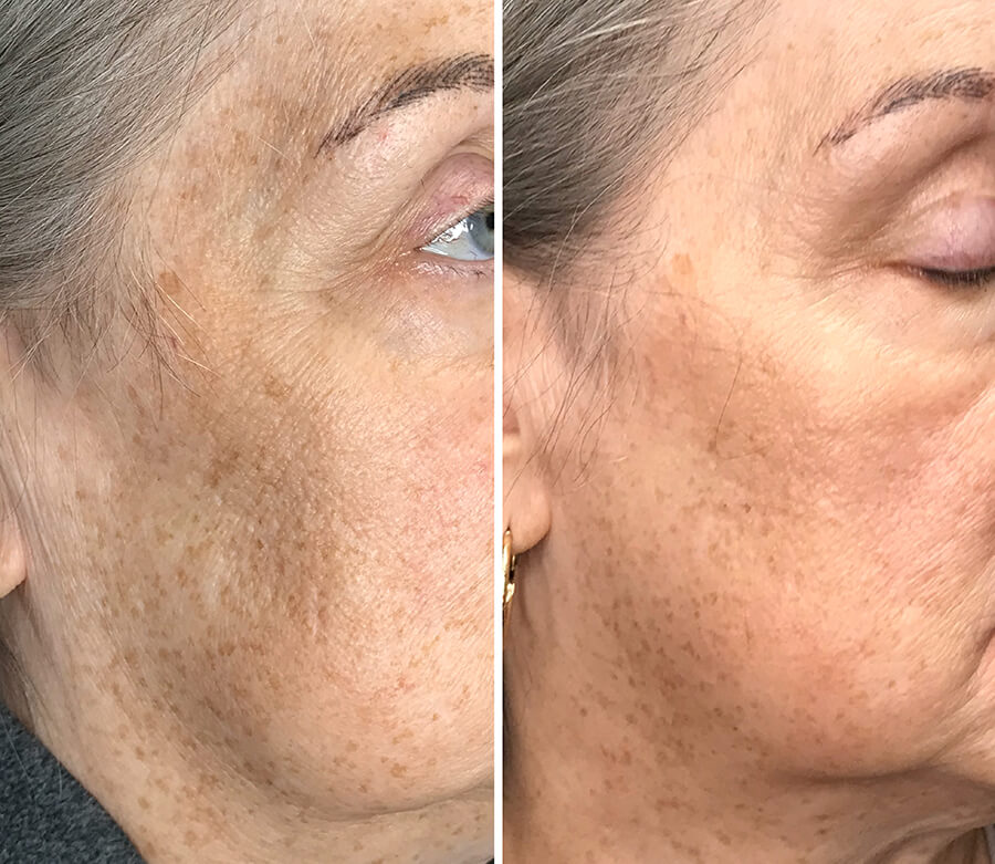 plaxel plasma treatment before and after