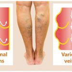Phlebectomy for varicose veins