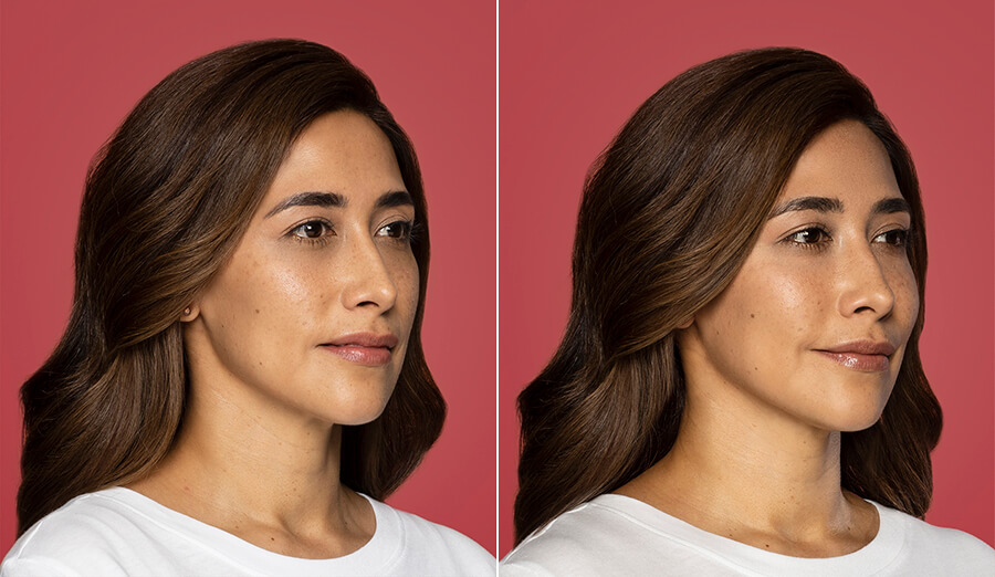 restylane-contour-before-and-after