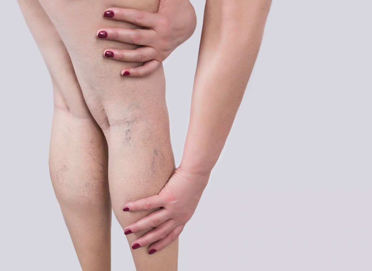 Can Diet Changes Improve Your Varicose Veins?: Soffer Health