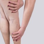woman touchIng her leg where she has varicose veins
