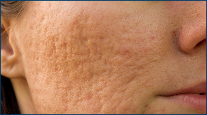 acne scars on woman's face