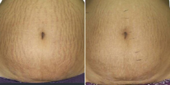 before and after venus viva stretch mark treatment for the abdomen