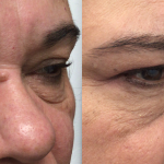 before and after morpheus8